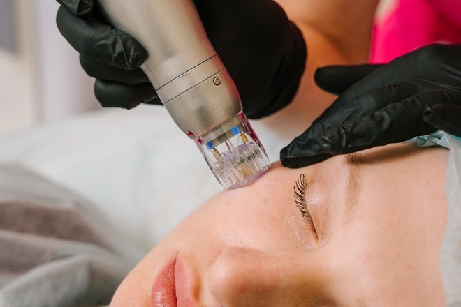 Микроигольчатый RF-лифтинг: инновационная процедура для омоложения кожи