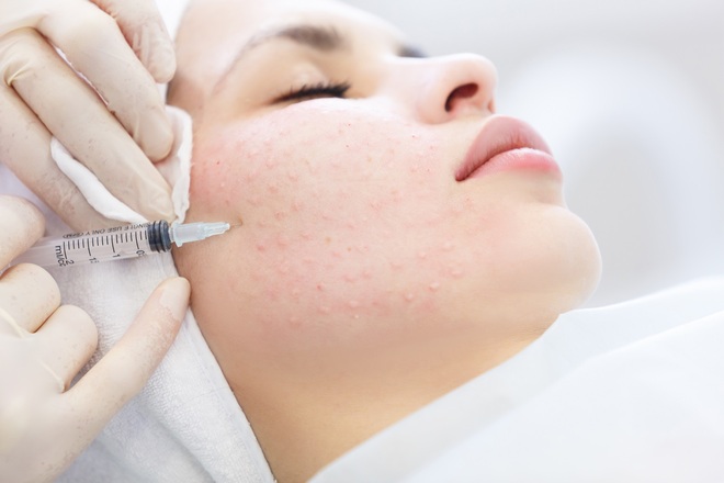 Биоревитализация гиалуроновой кислотой: эффективный способ омоложения кожи