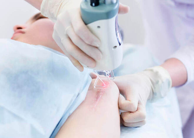 Лазерная шлифовка шрамов: эффективное лечение и регенерация кожи