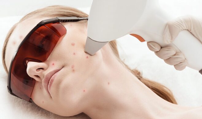 Лазерное удаление рубцов после акне: эффективные методы восстановления кожи
