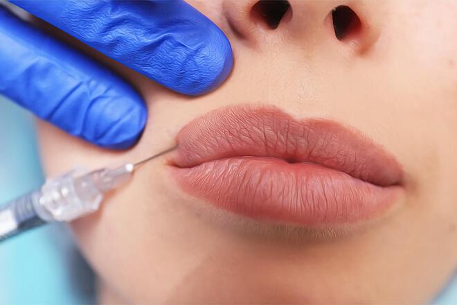 Увеличение губ гиалуроновой кислотой: безопасная и эффективная процедура