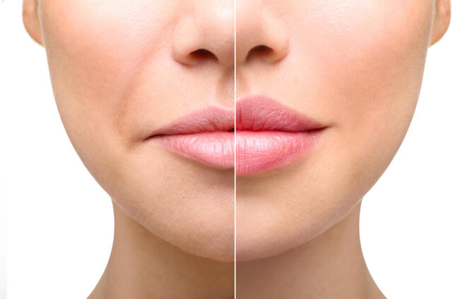 Увлажнение губ гиалуроновой кислотой: эффективный способ поддержания объема и упругости губ